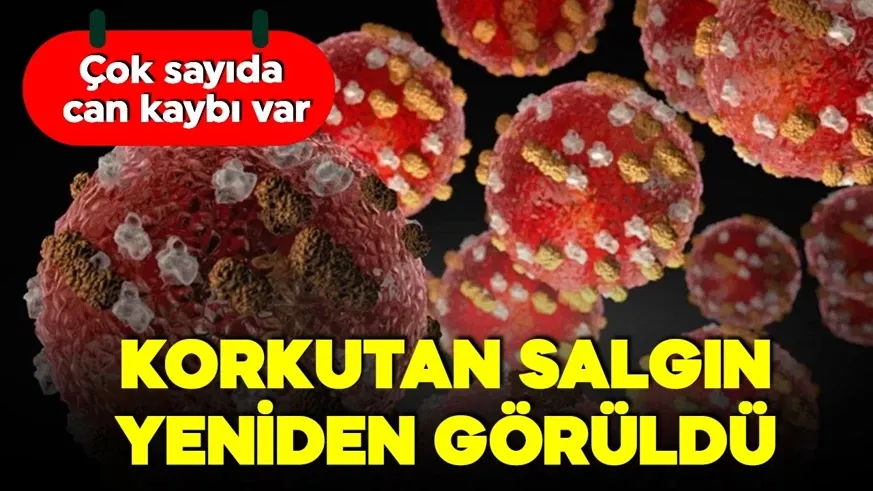 Kızamık salgını yeniden görüldü! Çok sayıda can kaybı var