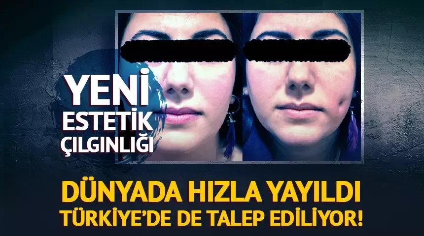 Yeni estetik çılgınlığı: Gamzeplasti ameliyatı sosyal medyada yayılıyor!